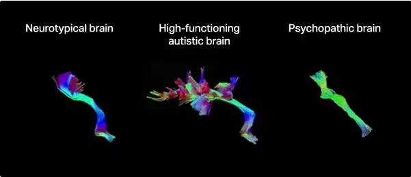 Aspergers vs normal vs psychopath.png