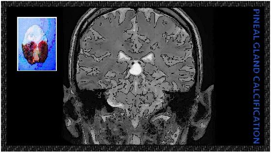 pineal gland calcification.jpg