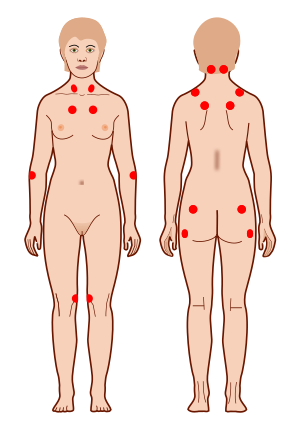 300px-Tender_points_fibromyalgia.svg.png